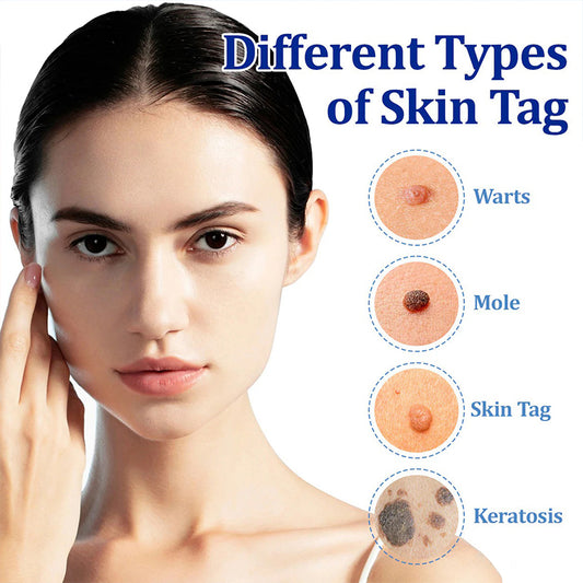 🐝RINGMOE™ BeeDerm Wart Solution—🚀 Sold out for the third time! 💥 Hot sale, hurry up! 🏃‍♀️