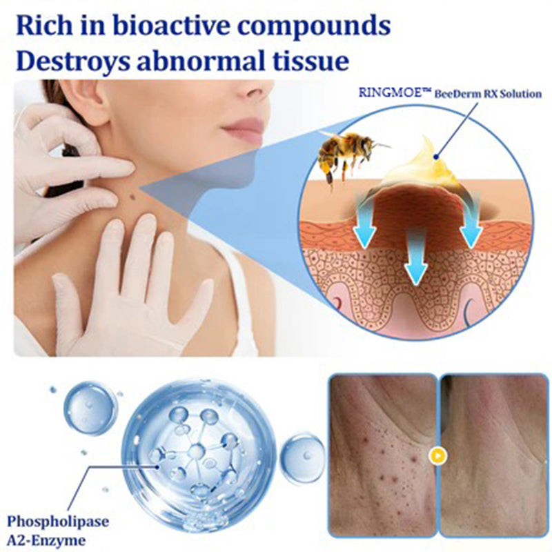 🐝RINGMOE™ BeeDerm Wart Solution—🚀 Sold out for the third time! 💥 Hot sale, hurry up! 🏃‍♀️