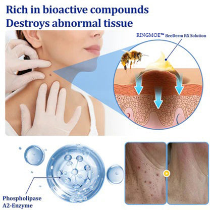 🐝RINGMOE™ BeeDerm Wart Solution—🚀 Sold out for the third time! 💥 Hot sale, hurry up! 🏃‍♀️