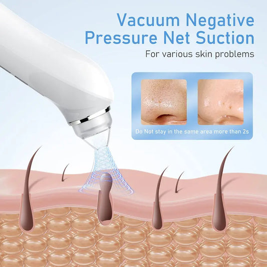🔥 [Limited Time Flash Sale] Blackhead Extractor! 60% off! 🚚 Free Shipping! 🔥