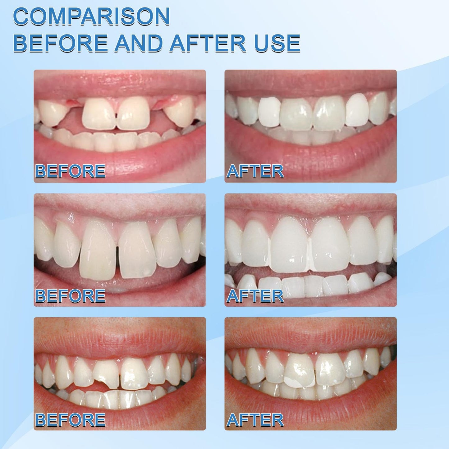Dental Filling Gel – Painless, Drill-Free Cavity Solution 💖💖 50% Off for a Limited Time💥⌛