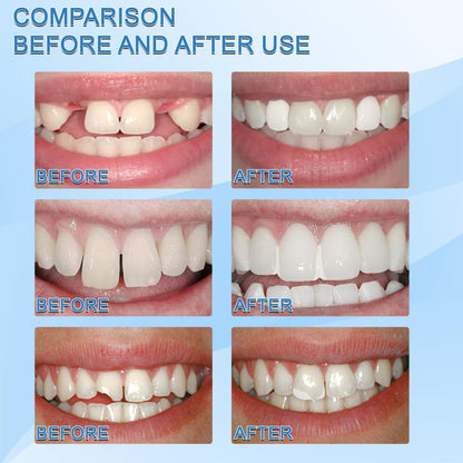 Dental Filling Gel – Painless, Drill-Free Cavity Solution 💖💖 50% Off for a Limited Time💥⌛