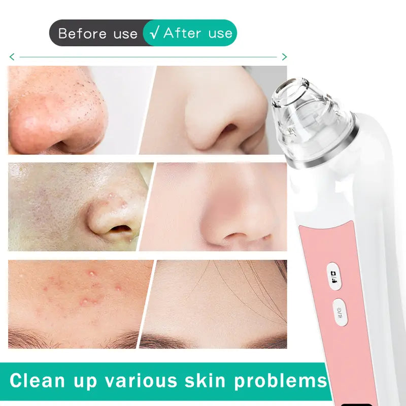 🔥 [Limited Time Flash Sale] Blackhead Extractor! 60% off! 🚚 Free Shipping! 🔥
