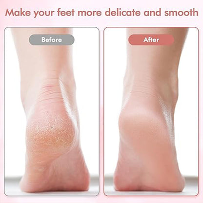🔥Limited Time Sale - Get 30% Off🔥 Electric Feet Callus Remover 💖[+ FREE Head! 🎁]