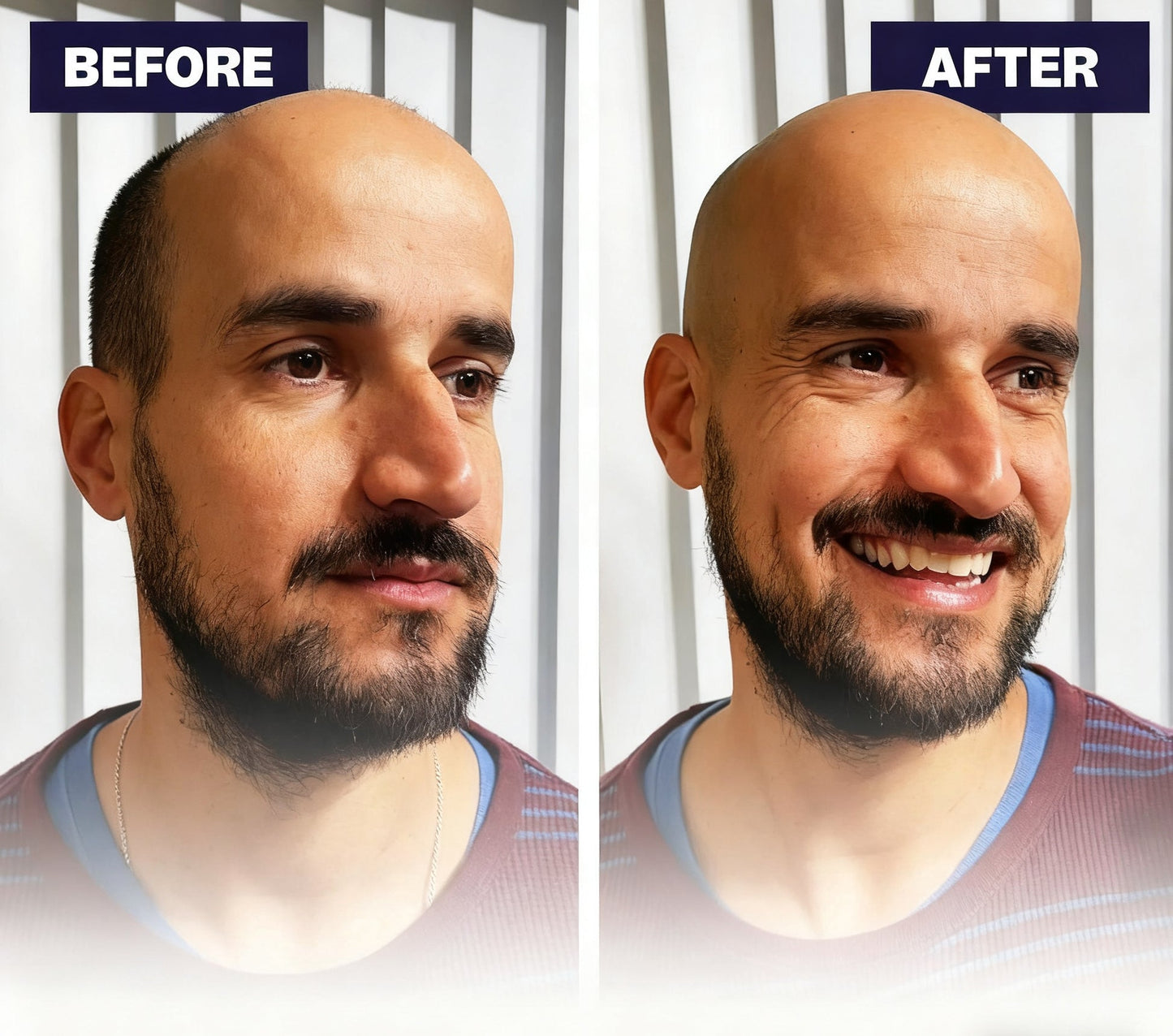 Effortless Head Shaving: Must-Have Shaver For Bald Guys