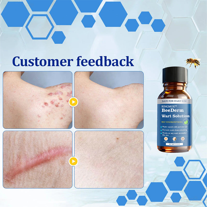 🐝RINGMOE™ BeeDerm Wart Solution—🚀 Sold out for the third time! 💥 Hot sale, hurry up! 🏃‍♀️