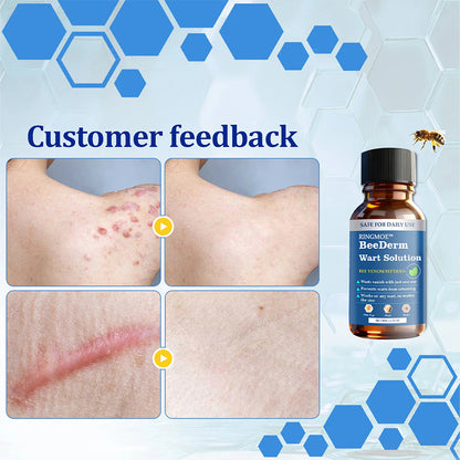 🐝RINGMOE™ BeeDerm Wart Solution—🚀 Sold out for the third time! 💥 Hot sale, hurry up! 🏃‍♀️