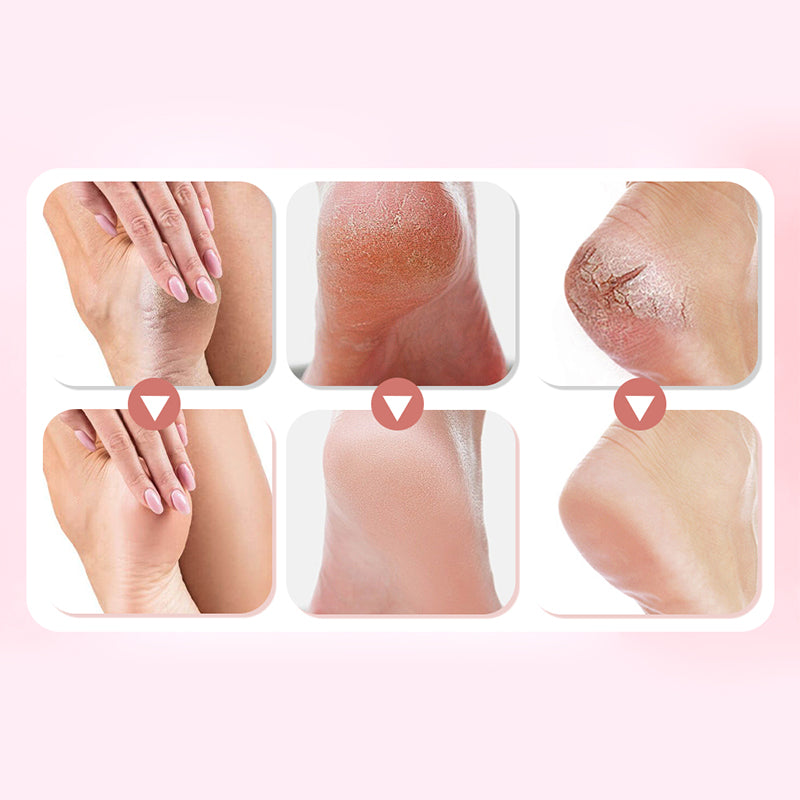 🔥Limited Time Sale - Get 30% Off🔥 Electric Feet Callus Remover 💖[+ FREE Head! 🎁]