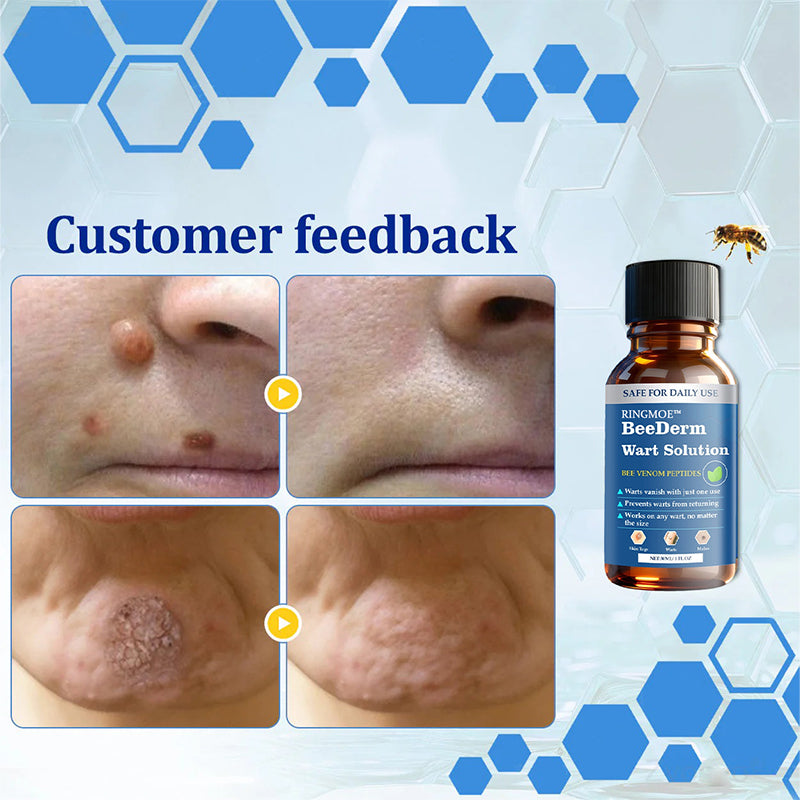 🐝RINGMOE™ BeeDerm Wart Solution—🚀 Sold out for the third time! 💥 Hot sale, hurry up! 🏃‍♀️