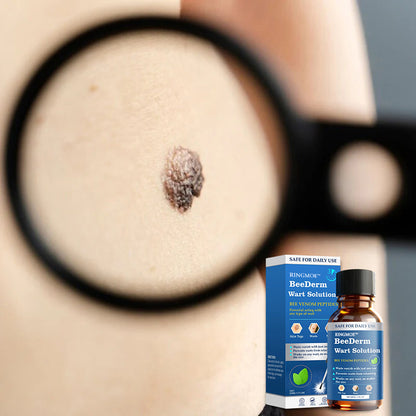 🐝RINGMOE™ BeeDerm Wart Solution—🚀 Sold out for the third time! 💥 Hot sale, hurry up! 🏃‍♀️