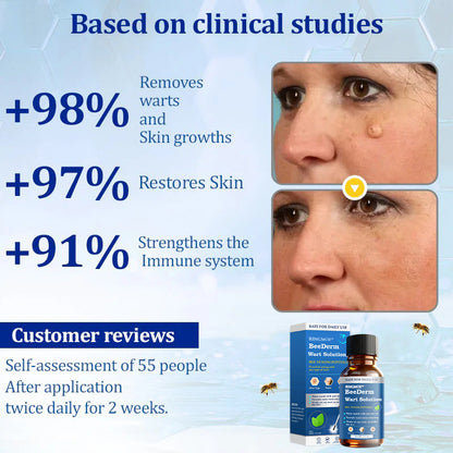 🐝RINGMOE™ BeeDerm Wart Solution—🚀 Sold out for the third time! 💥 Hot sale, hurry up! 🏃‍♀️